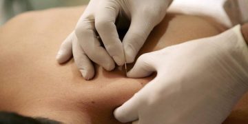 Have you guys heard about dry needling before?