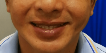 Facial palsy (Facial muscle weakness)