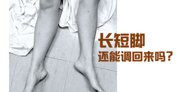 #假性长短脚案例分析
