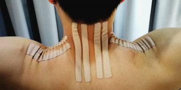 【落枕】两个礼拜不会好，最后却是做了这项治疗而康复了！