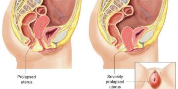 #Prolapsed uterus/ Rahim jatuh/ Rahim longgar?