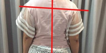 Rawatan “Dry Needling” Sangat Berkesan Untuk Membantu Merawat Sakit Leher Dan Bahu