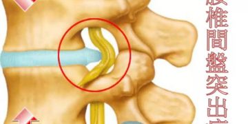 一个决定让她避开了万元的手术费